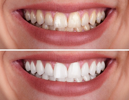 before-and-after teeth whitening picture of a person smiling