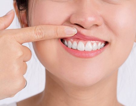 a woman showing signs of gum disease